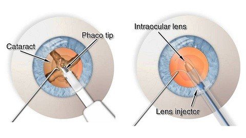 Should I Go for a Costly Lens for My Cataract Surgery?