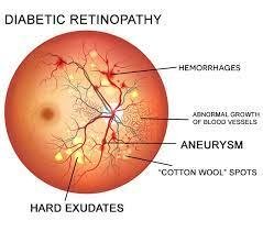 Protecting Your Eye from Diabetes Related Eye Problems