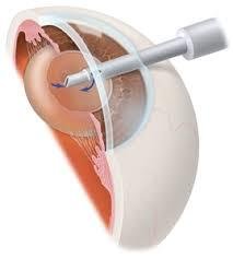Should One Undergo Same Day Both Eye Cataract Surgery?