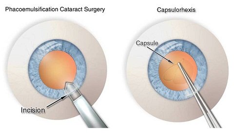 Smooth Recovery from Cataract Surgery