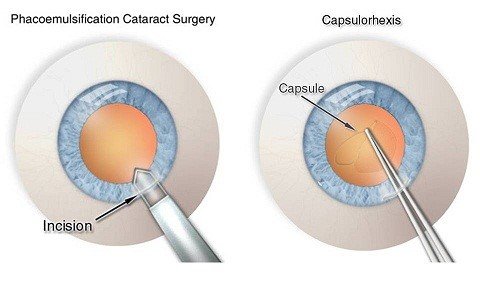 MYTHS AND FACTS OF MODERN CATARACT SURGERY – 1