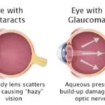 Differences Between Cataract and Glaucoma