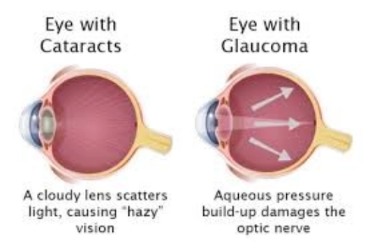 Know More About Glaucoma