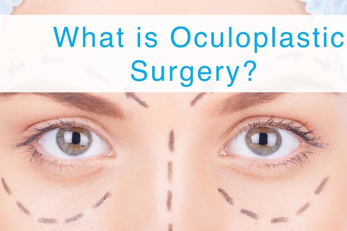 Know More About Oculoplasty Surgery