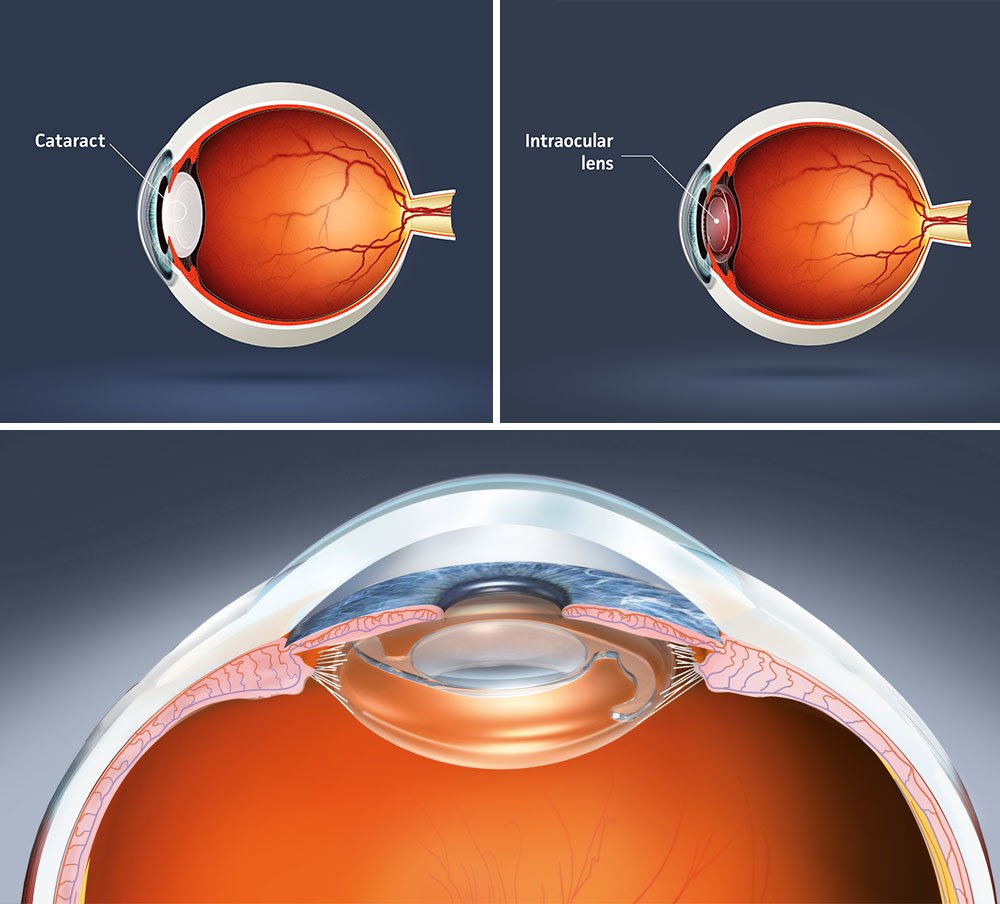 Cataract Surgery: What to Expect Before and After